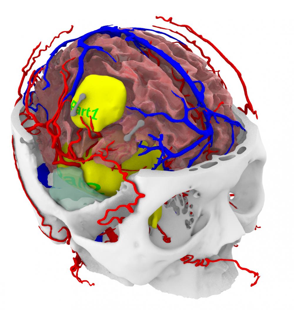 神經(jīng)外科大腦膠質(zhì)瘤3D打印模型